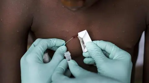 Wykreowana epidemia, a przyczyną są szczepionki - teorie spiskowe o małpiej ospie